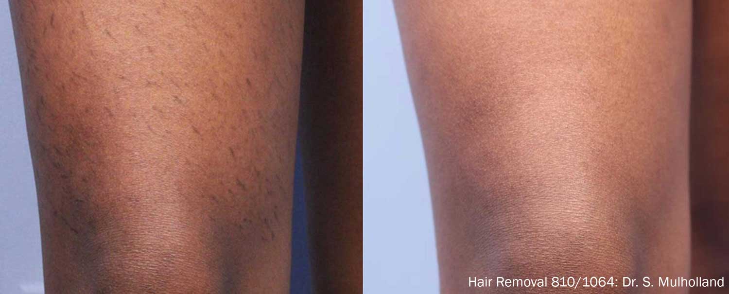  Hair-Removal-Darker-Skin-Tone-Before-After